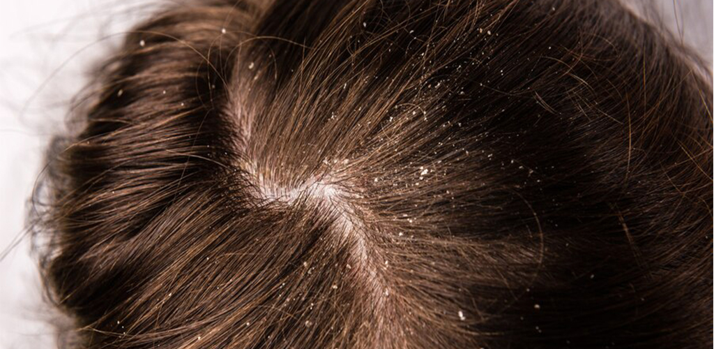 How to Get Rid of Dandruff? - Eshaistic Blog