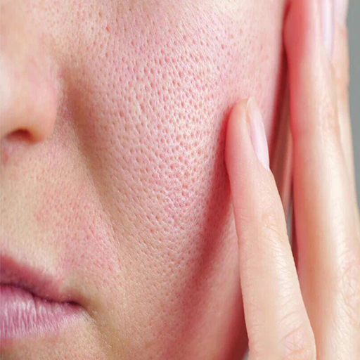 large pores adult skin problems